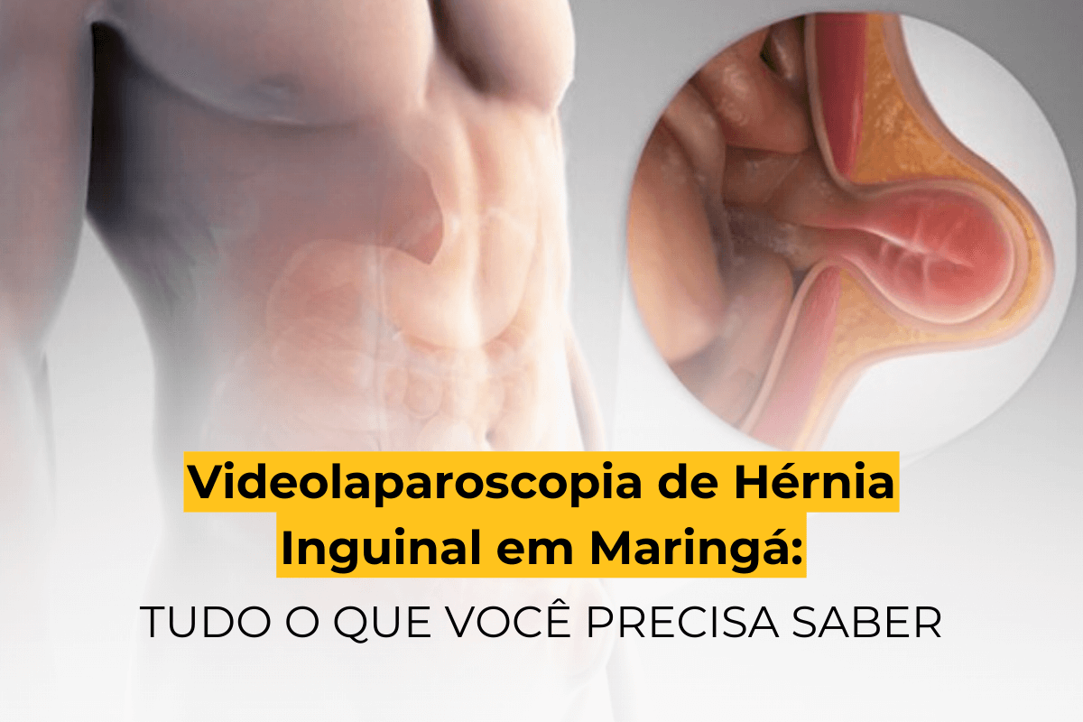 Videolaparoscopia de Hérnia Inguinal em Maringá: Tudo o Que Você Precisa Saber