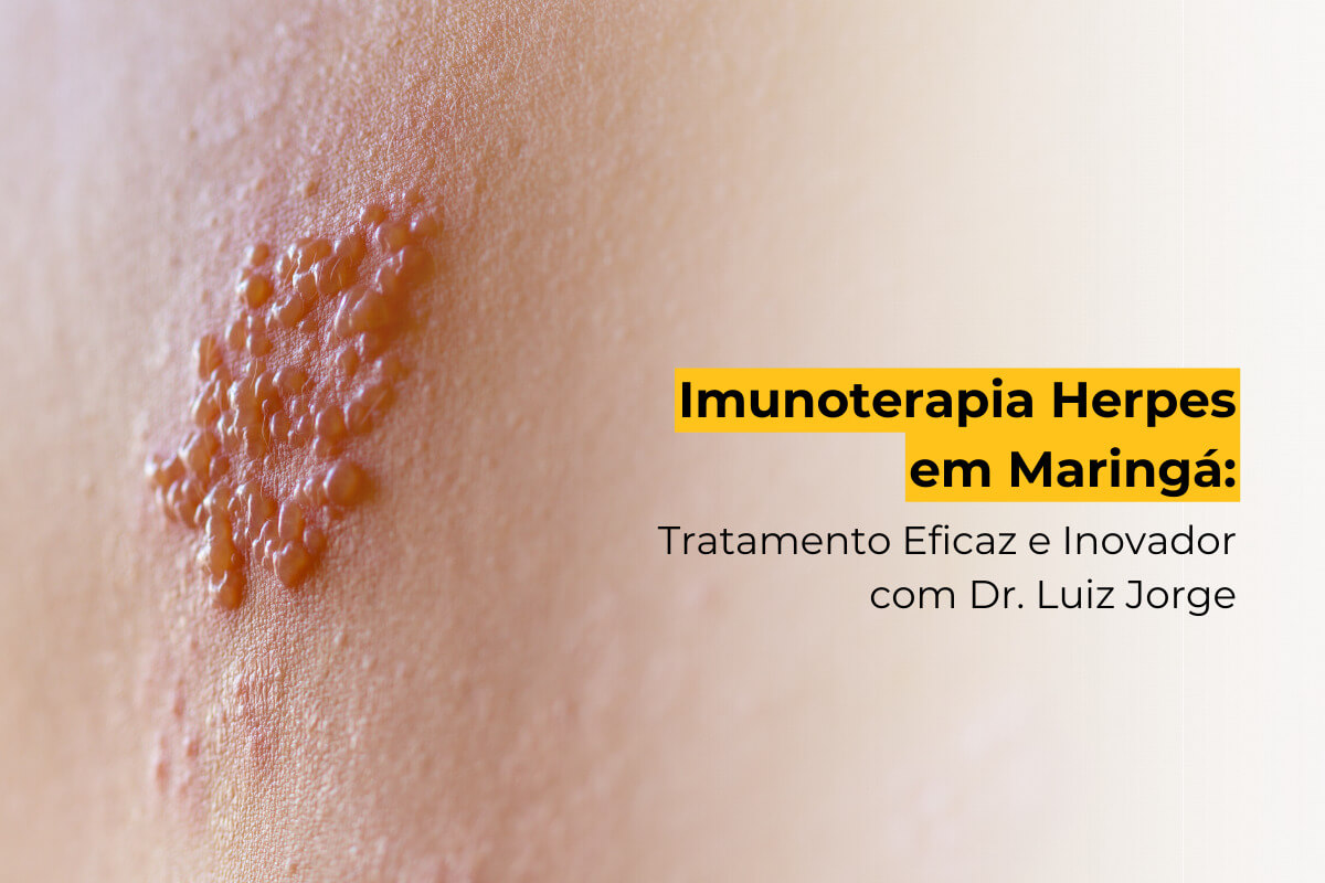 Imunoterapia Herpes em Maringá: Tratamento Eficaz e Inovador com Dr. Luiz Jorge
