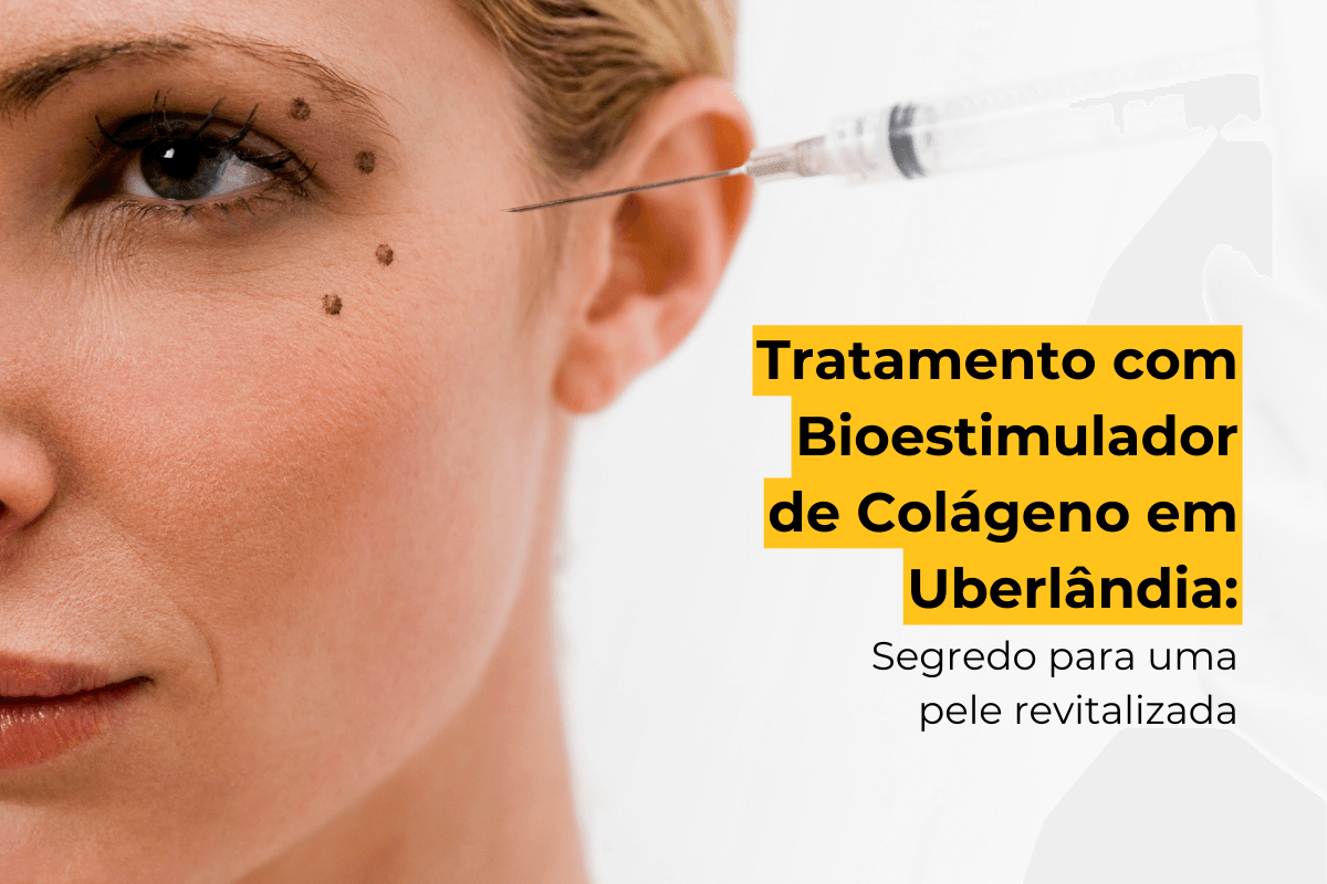 Tratamento com Bioestimulador de Colágeno em Uberlândia: A Solução para uma Pele Mais Jovem e Saudável