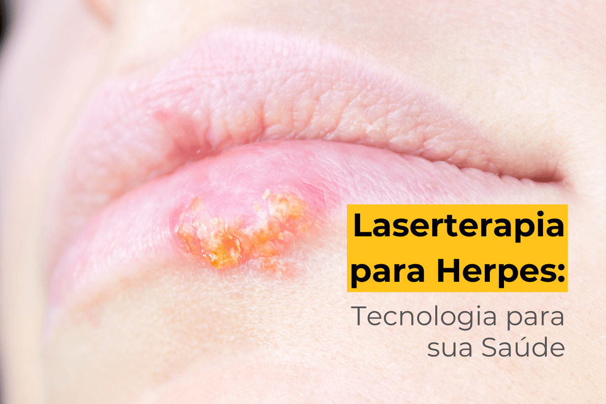 Laserterapia para Herpes Maringá: Tecnologia para sua Saúde