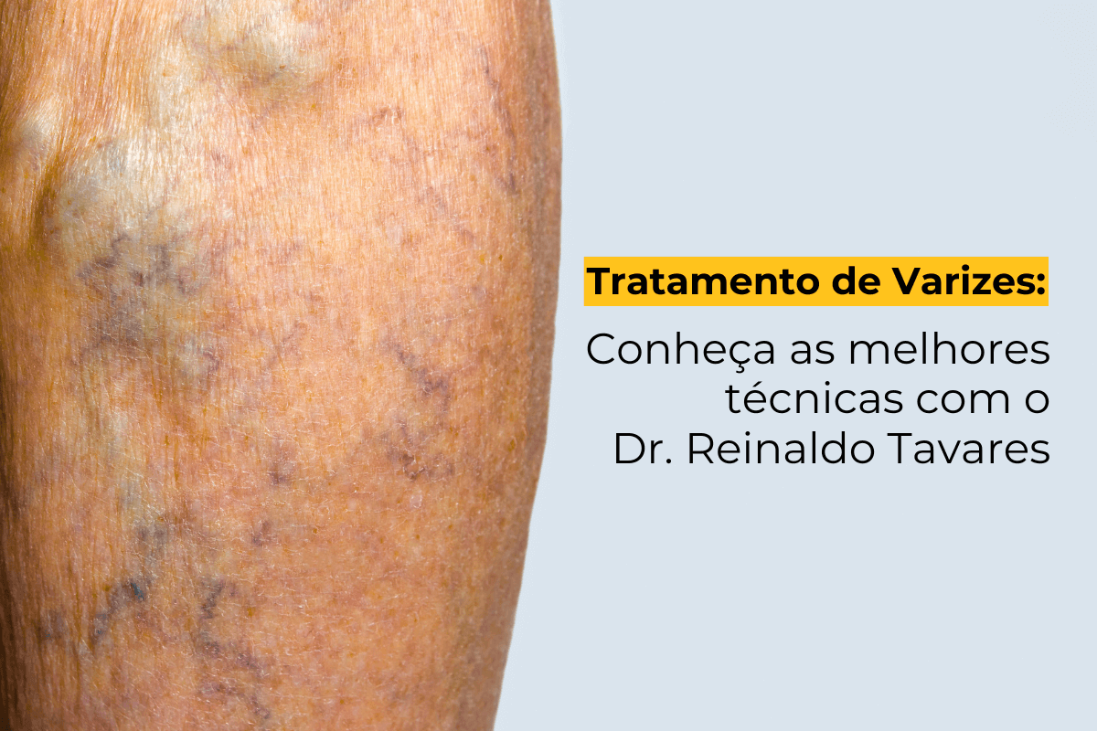 Tratamento de Varizes em Maringá: Conheça as Melhores Técnicas com o Dr. Reinaldo Tavares