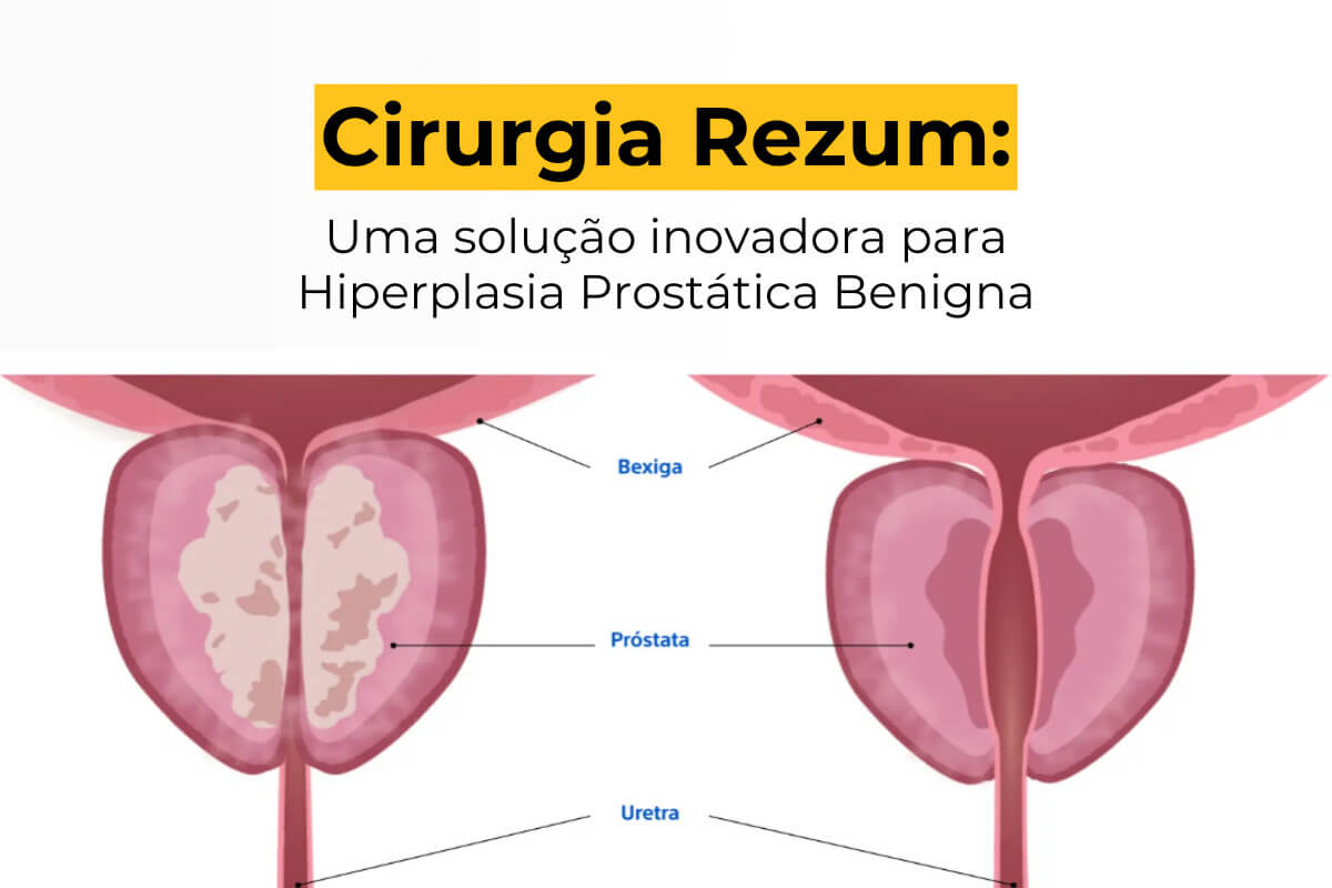 Cirurgia Rezum Maringá: Uma Solução Inovadora para Hiperplasia Prostática Benigna