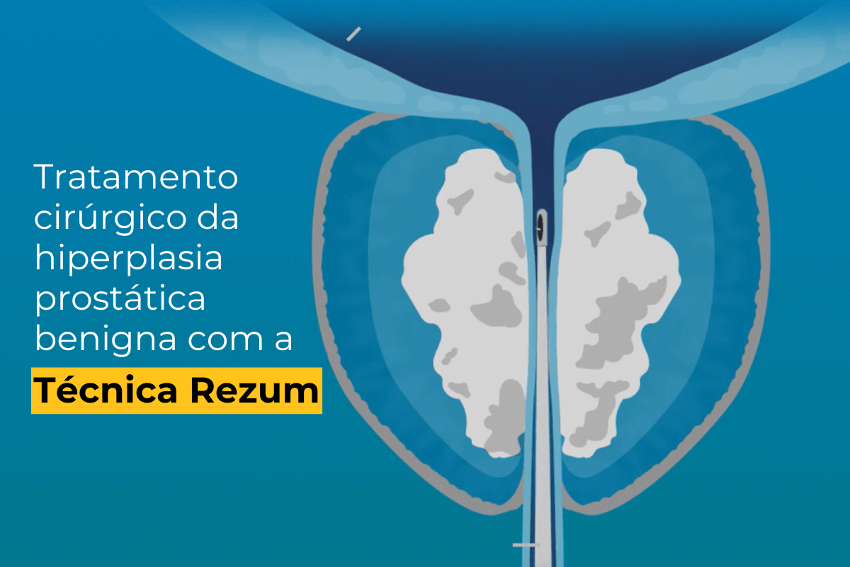 Tratamento Cirúrgico em Maringá da Hiperplasia Prostática Benigna com a Técnica Rezum