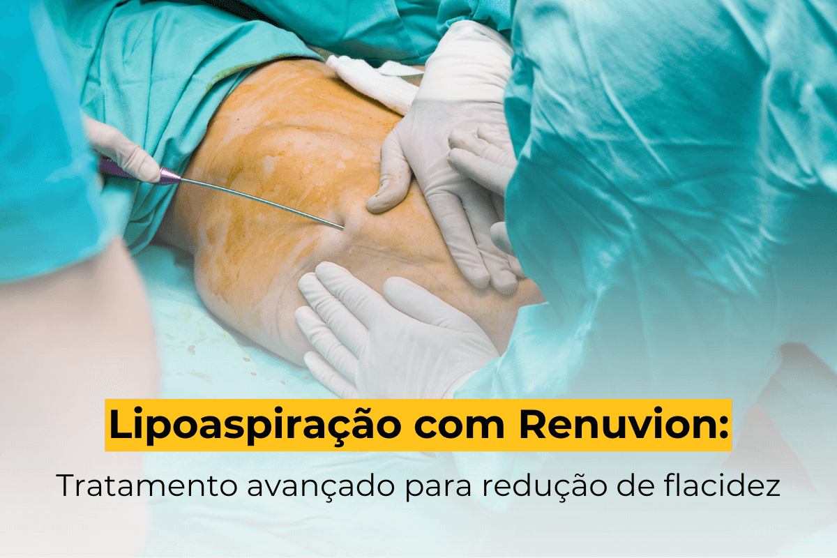 Lipoaspiração com Renuvion em Uberlândia: Tratamento Avançado para Redução de Flacidez