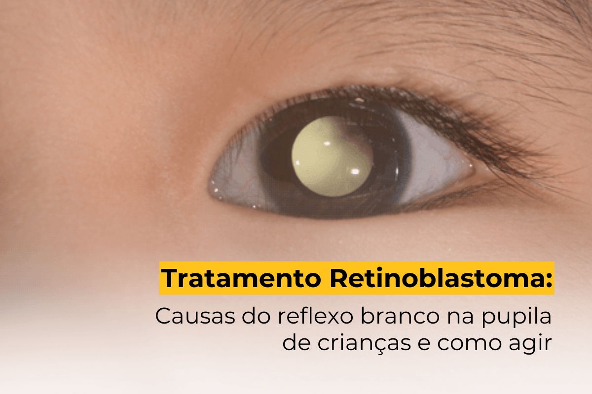 Diagnóstico do Retinoblastoma Maringá: Causas do Reflexo Branco na Pupila de Crianças e Como Agir