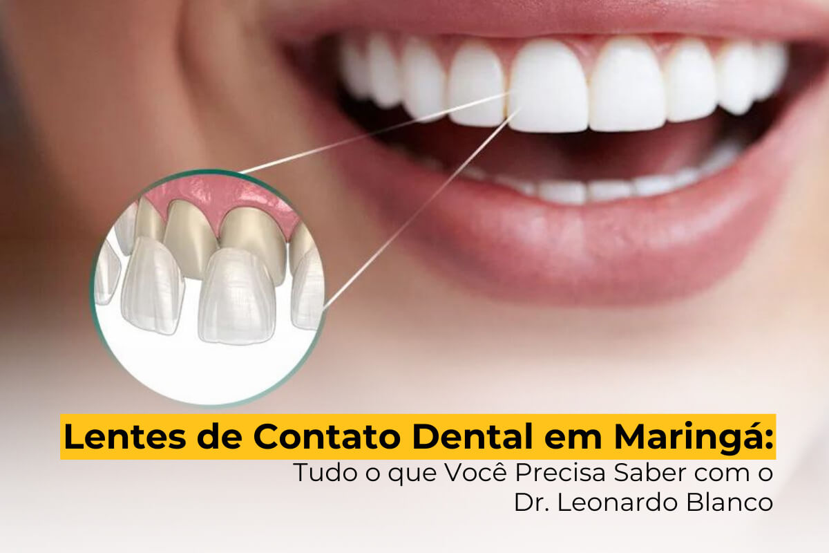 Lentes de Contato Dental em Maringá: Tudo o que Você Precisa Saber com o Dr. Leonardo Blanco