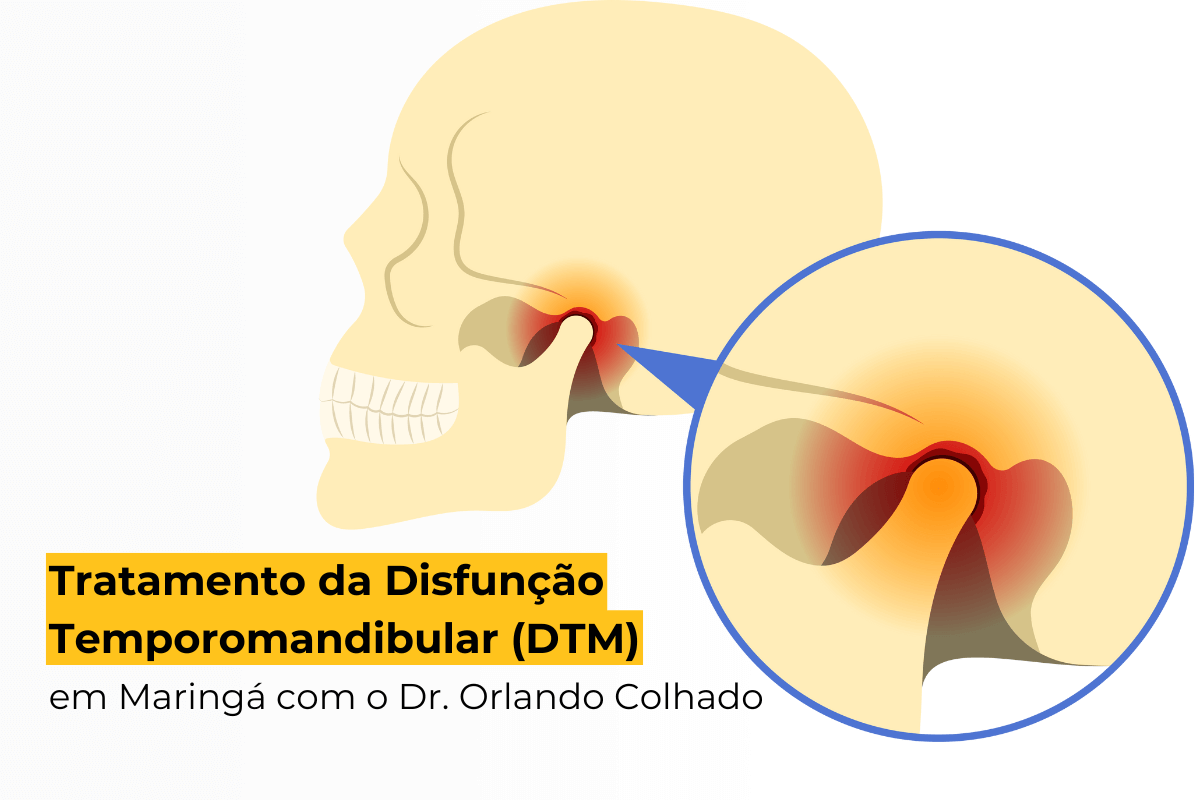 Tratamento da Disfunção Temporomandibular (DTM) em Maringá com o Dr. Orlando Colhado