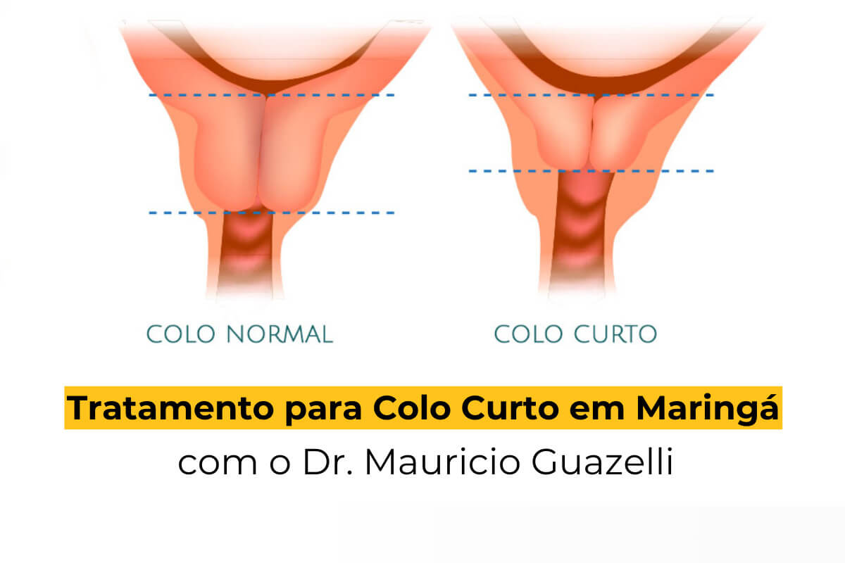 Tratamento para Colo Curto em Maringá com o Dr. Mauricio Guazelli