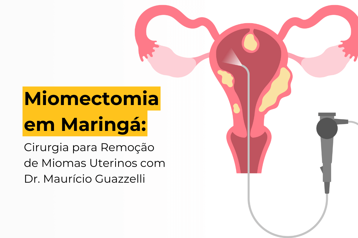 Miomectomia em Maringá: Cirurgia para Remoção de Miomas Uterinos com Dr. Maurício Guazzelli