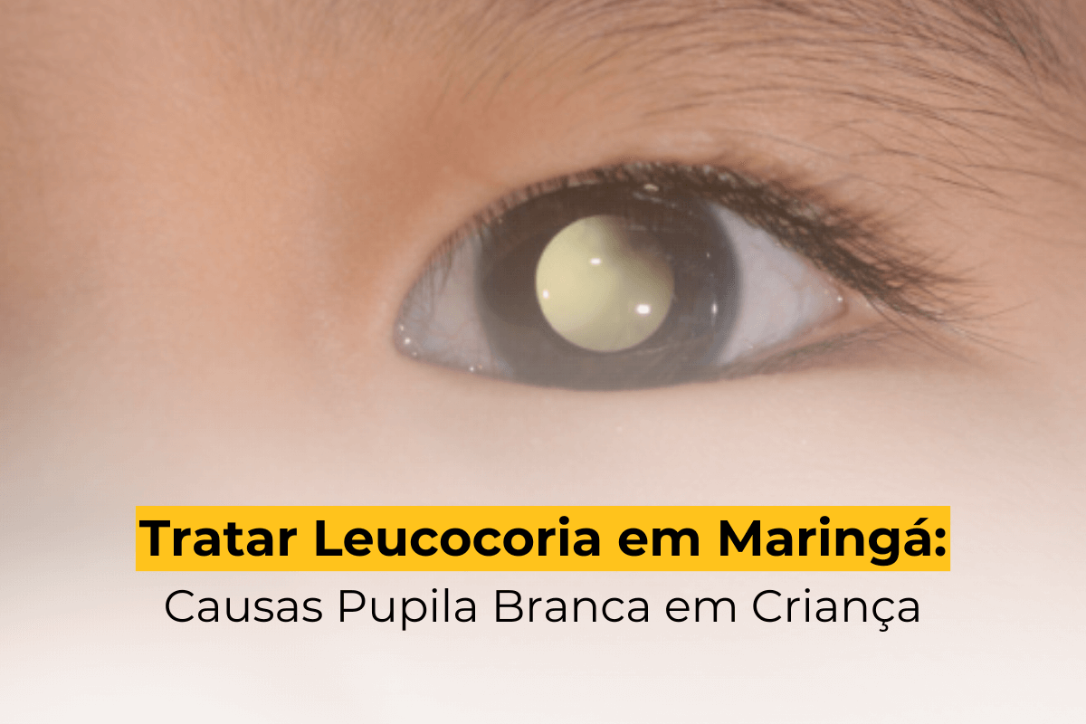 Tratar Leucocoria em Maringá: Causas Pupila Branca em Criança