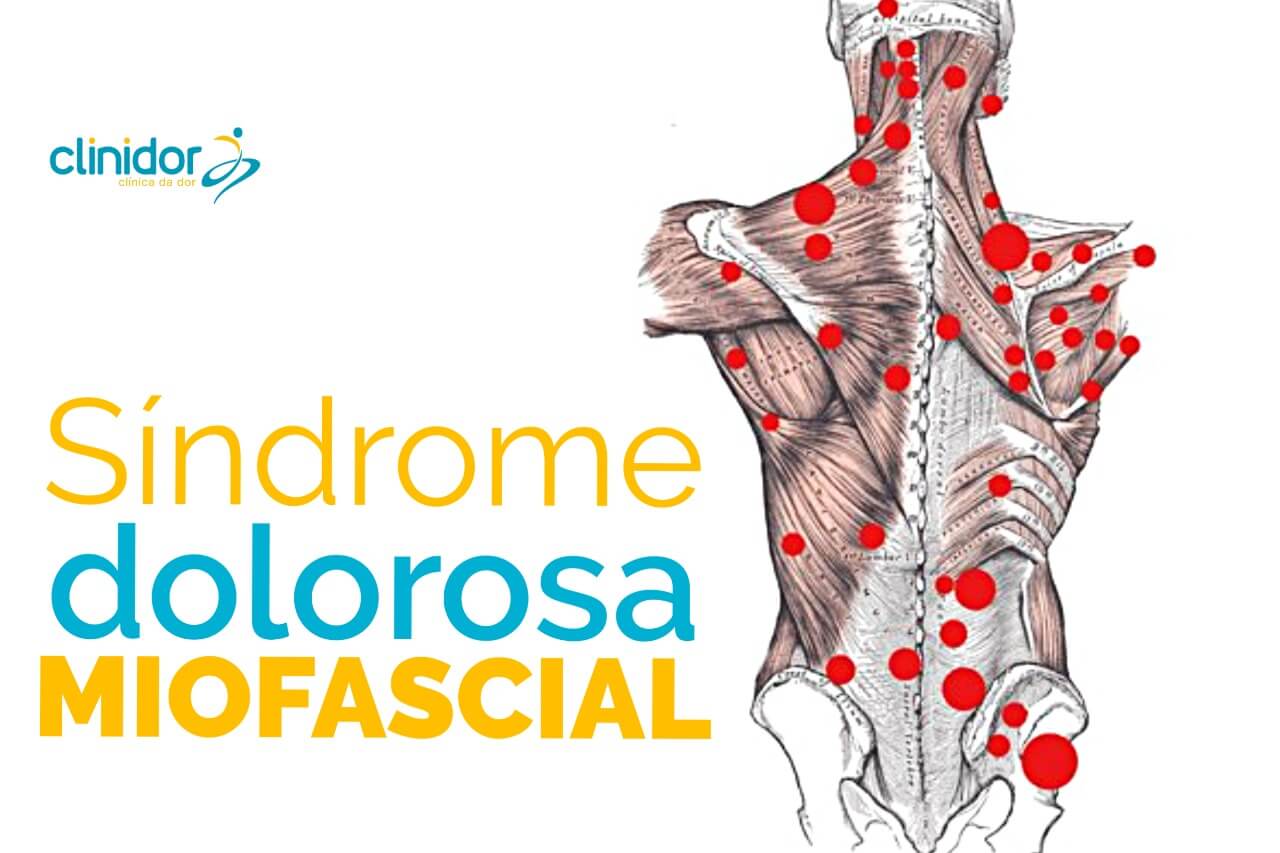 S Ndrome Dolorosa Miofascial Guia Sa De Cidades