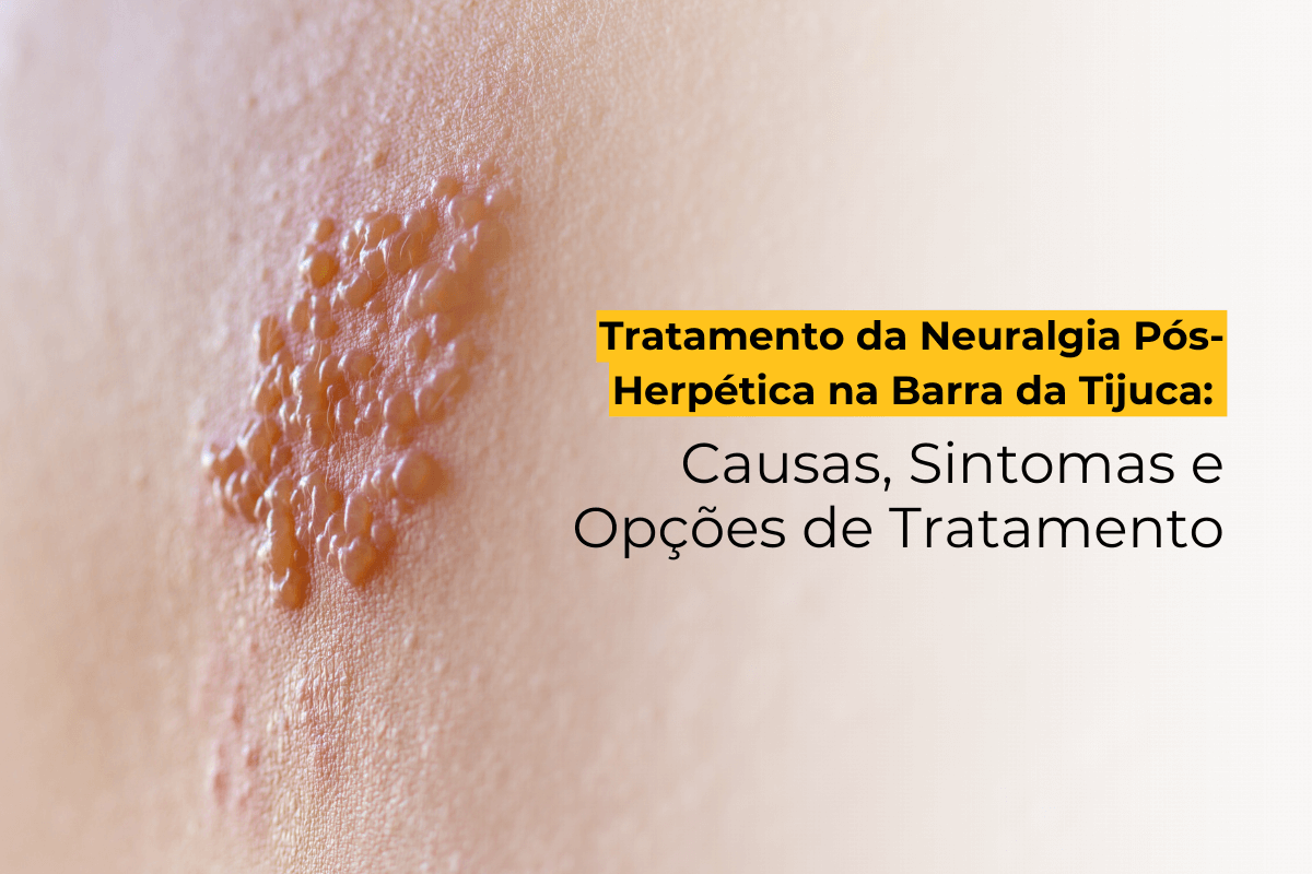 Tratamento da Neuralgia Pós-Herpética na Barra da Tijuca: Causas, Sintomas e Opções de Tratamento