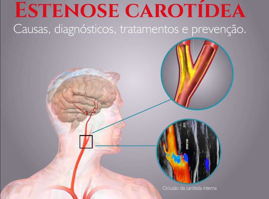 Estenose carotídea Causas diagnóstico tratamentos e prevenção Guia Saúde Cidades